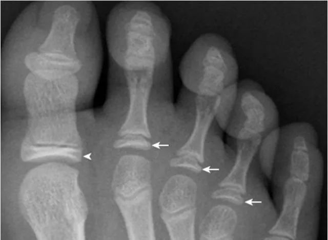 足部正常的及常见病变的 X 线表现-22