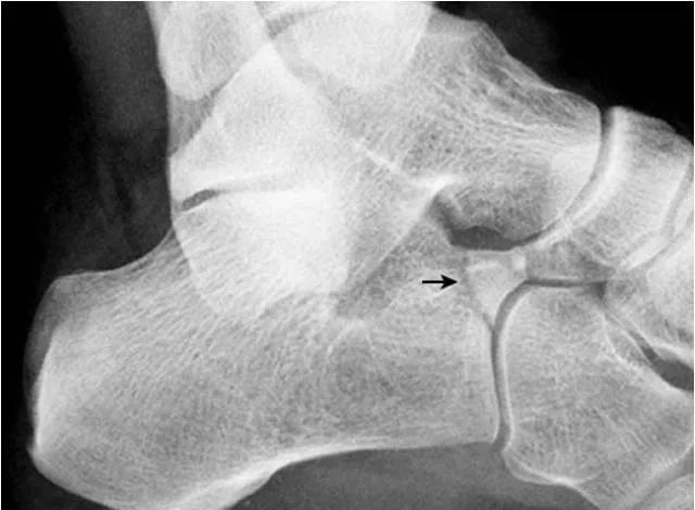 足部正常的及常见病变的 X 线表现-24