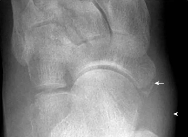 足部正常的及常见病变的 X 线表现-26