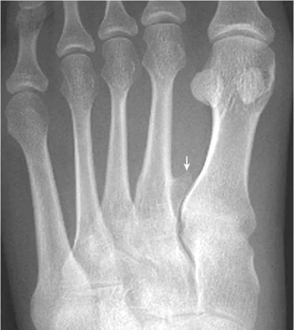 足部正常的及常见病变的 X 线表现-29