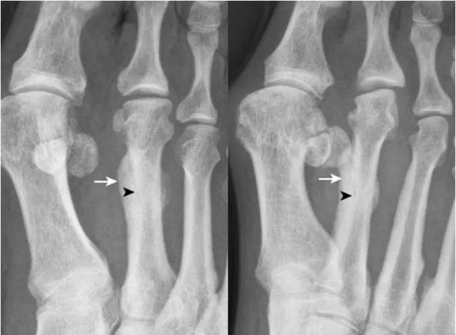 足部正常的及常见病变的 X 线表现-28