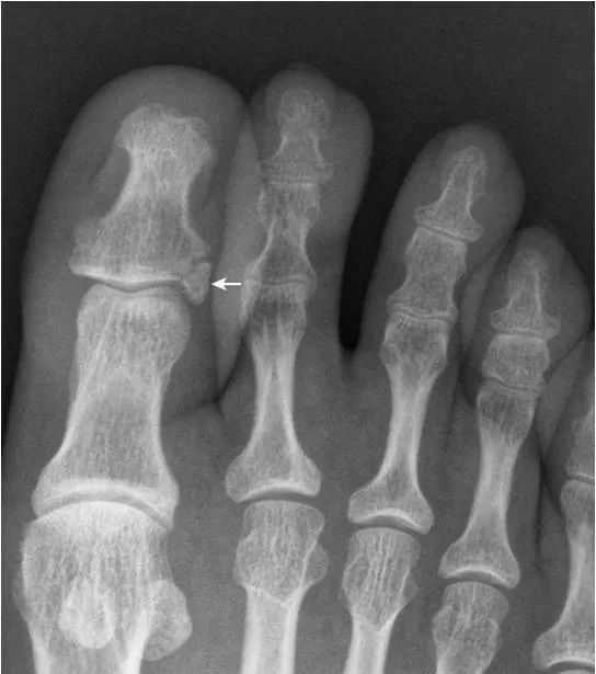 足部正常的及常见病变的 X 线表现-31
