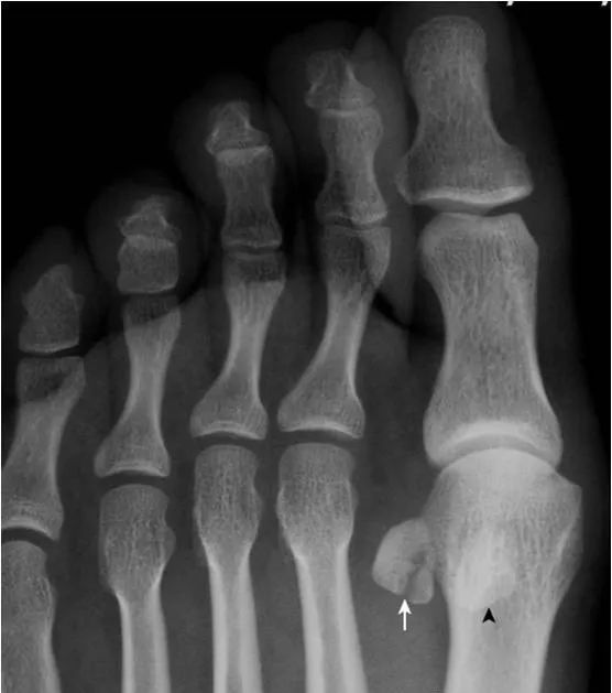 足部正常的及常见病变的 X 线表现-32