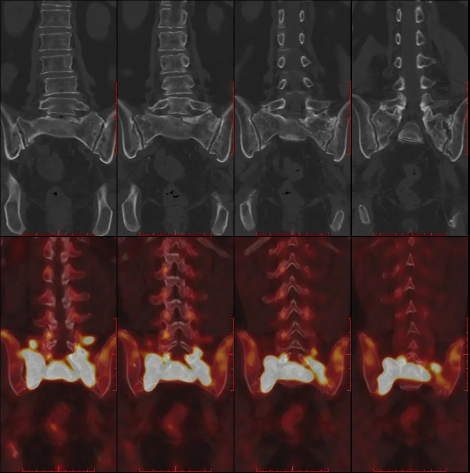行驶在骶骨的本田车标—骶骨机能不全骨折-2