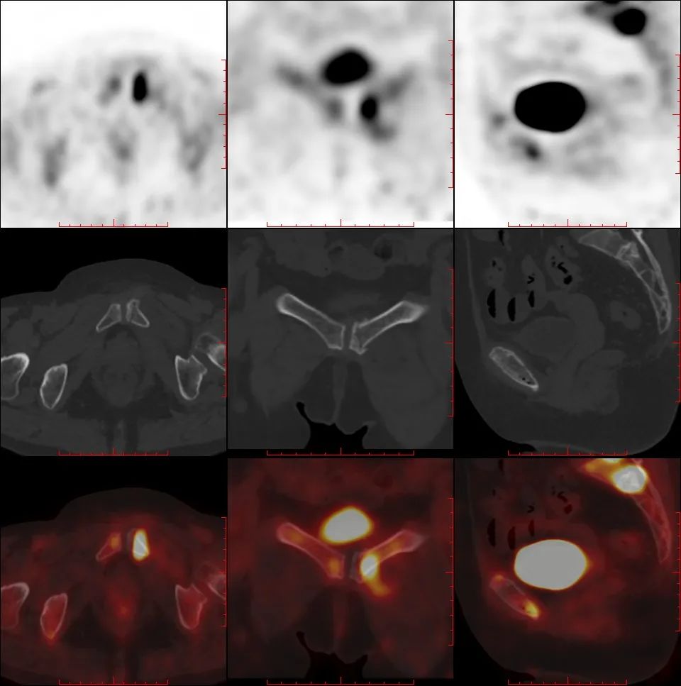 行驶在骶骨的本田车标—骶骨机能不全骨折-3