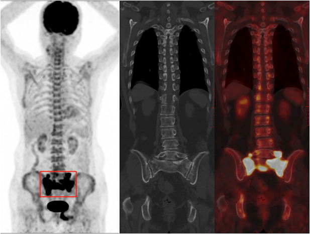 行驶在骶骨的本田车标—骶骨机能不全骨折-1