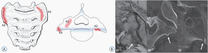 行驶在骶骨的本田车标—骶骨机能不全骨折-5