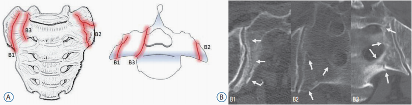 行驶在骶骨的本田车标—骶骨机能不全骨折-6