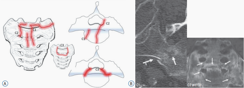 行驶在骶骨的本田车标—骶骨机能不全骨折-7