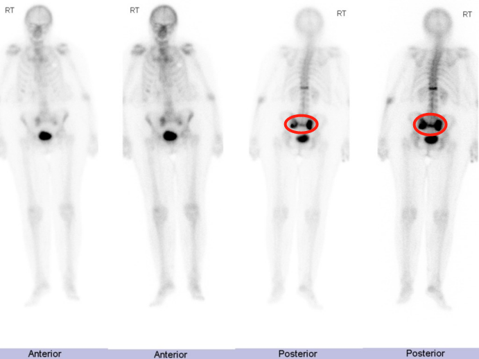 行驶在骶骨的本田车标—骶骨机能不全骨折-8