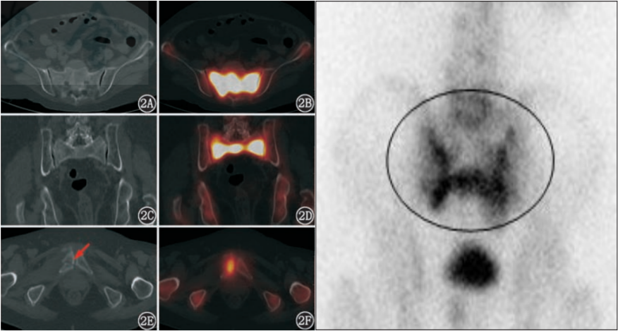 行驶在骶骨的本田车标—骶骨机能不全骨折-9