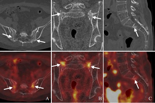 行驶在骶骨的本田车标—骶骨机能不全骨折-10
