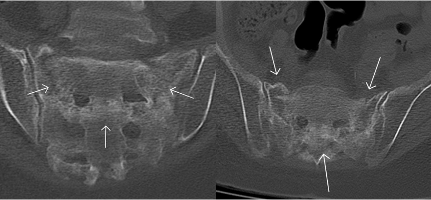 行驶在骶骨的本田车标—骶骨机能不全骨折-11