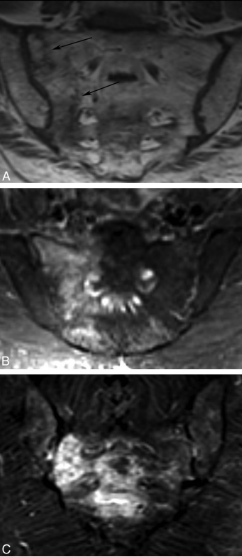 行驶在骶骨的本田车标—骶骨机能不全骨折-13