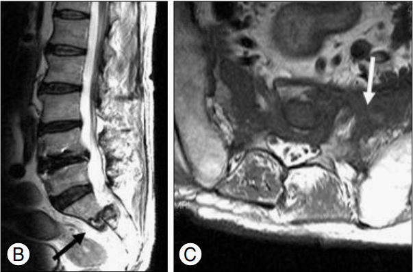 行驶在骶骨的本田车标—骶骨机能不全骨折-14