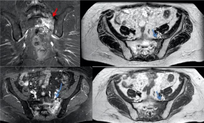 行驶在骶骨的本田车标—骶骨机能不全骨折-15