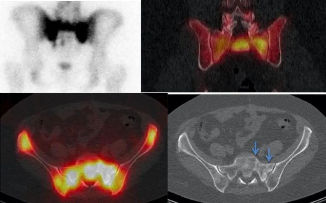 行驶在骶骨的本田车标—骶骨机能不全骨折-16
