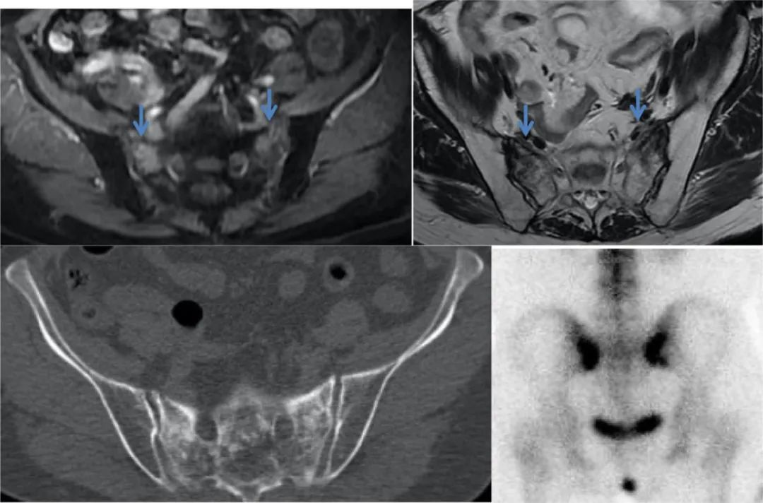 行驶在骶骨的本田车标—骶骨机能不全骨折-17