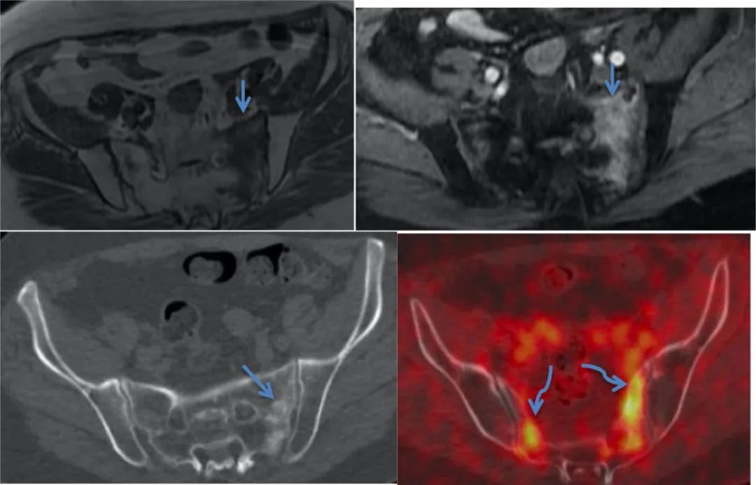 行驶在骶骨的本田车标—骶骨机能不全骨折-18