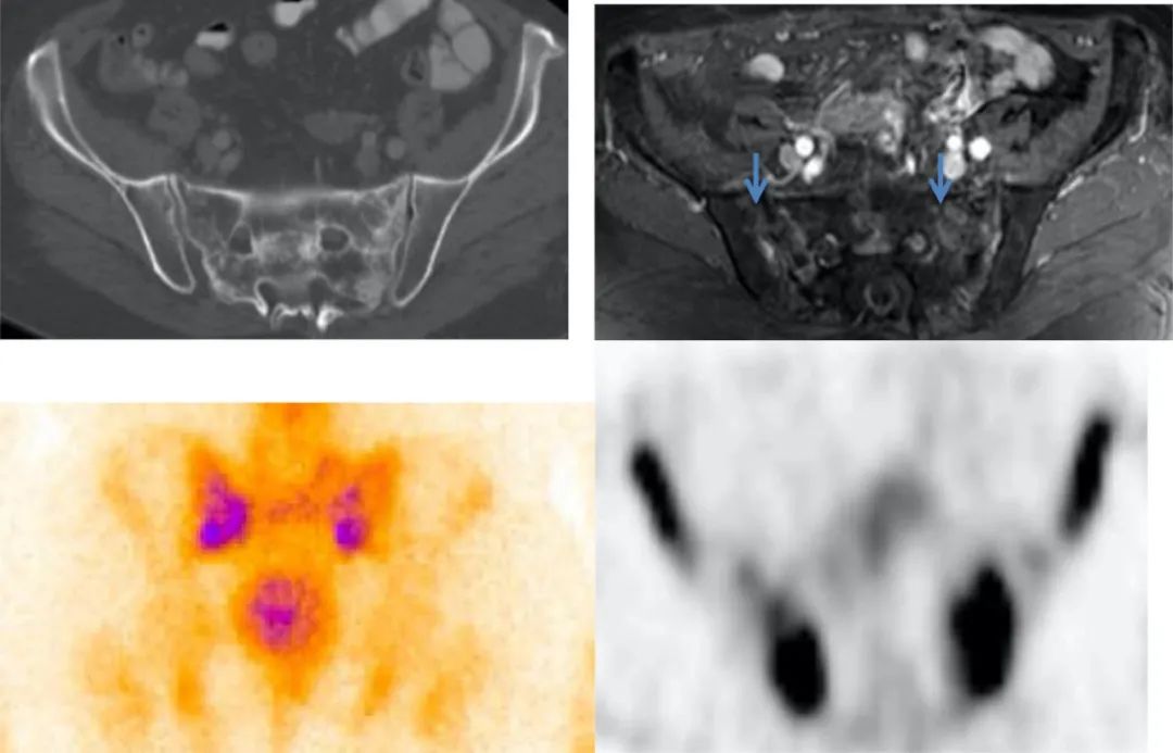 行驶在骶骨的本田车标—骶骨机能不全骨折-19