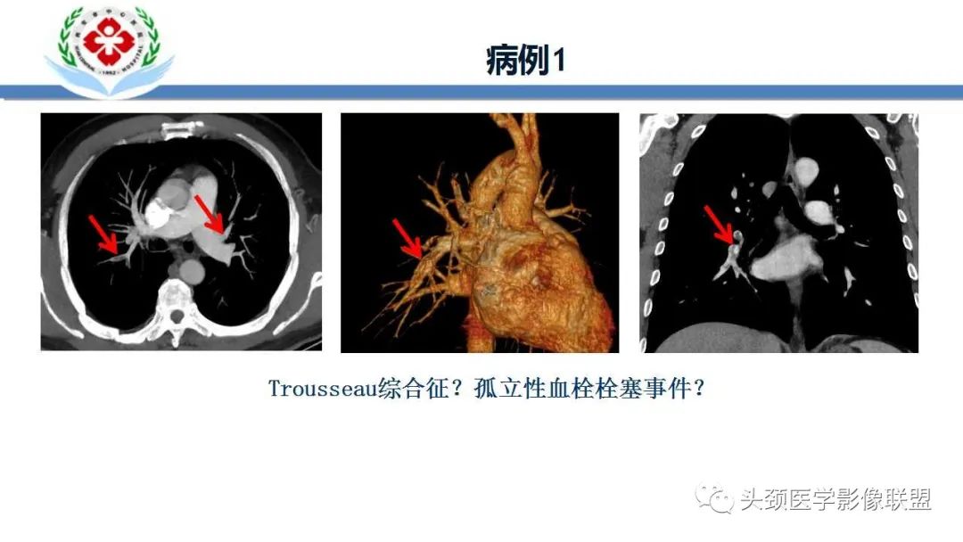 【PPT】特鲁索综合征-3