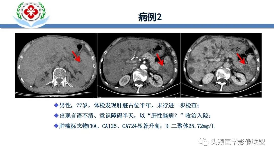 【PPT】特鲁索综合征-4