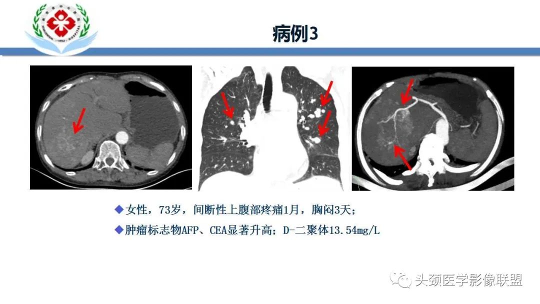 【PPT】特鲁索综合征-6