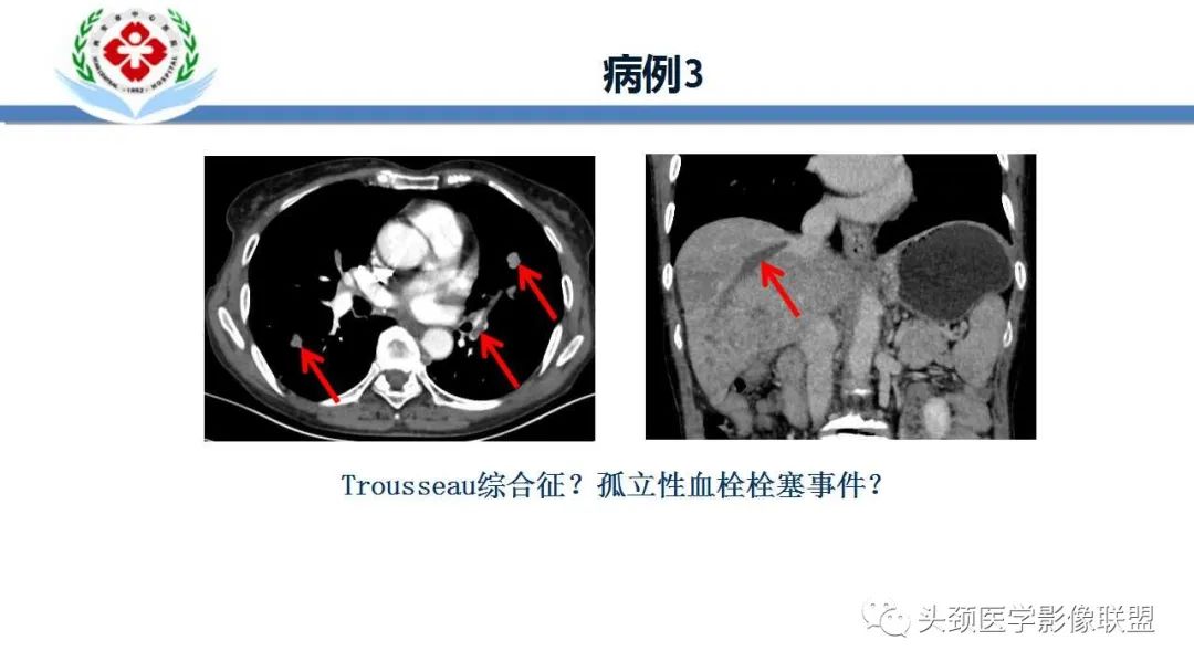 【PPT】特鲁索综合征-7