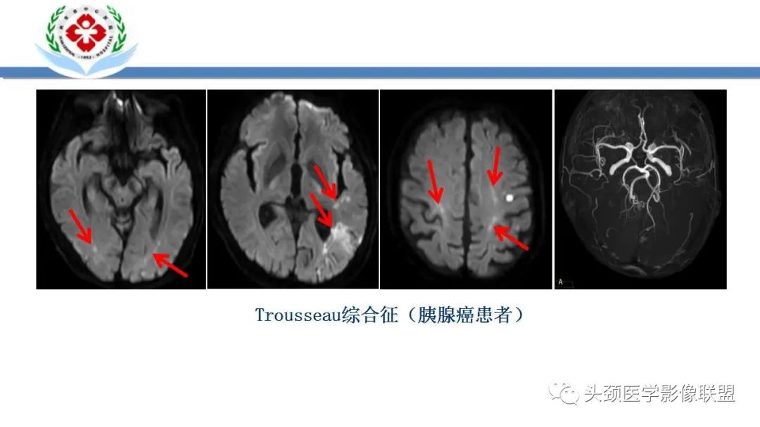 【PPT】特鲁索综合征-15