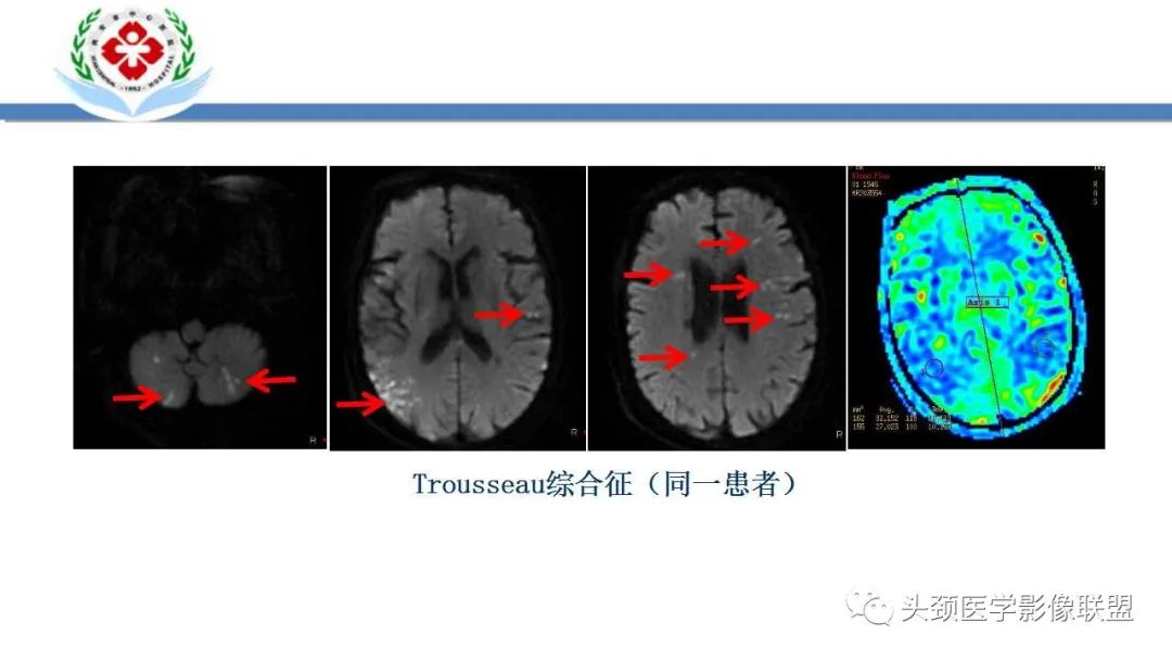 【PPT】特鲁索综合征-17