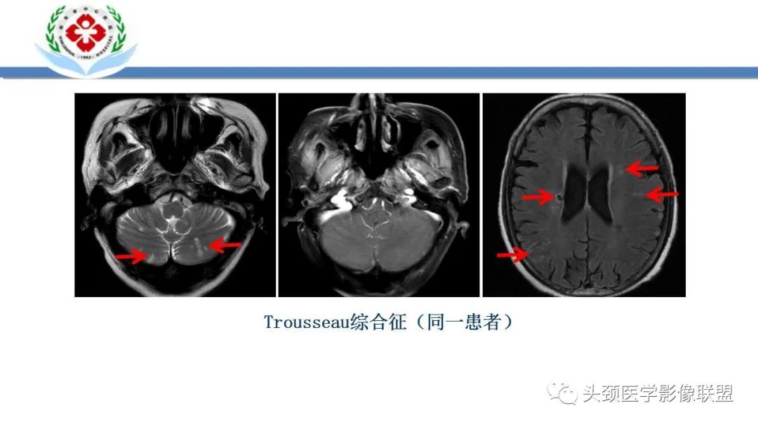 【PPT】特鲁索综合征-18
