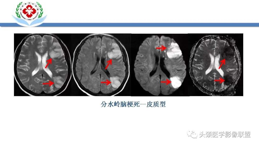 【PPT】特鲁索综合征-25