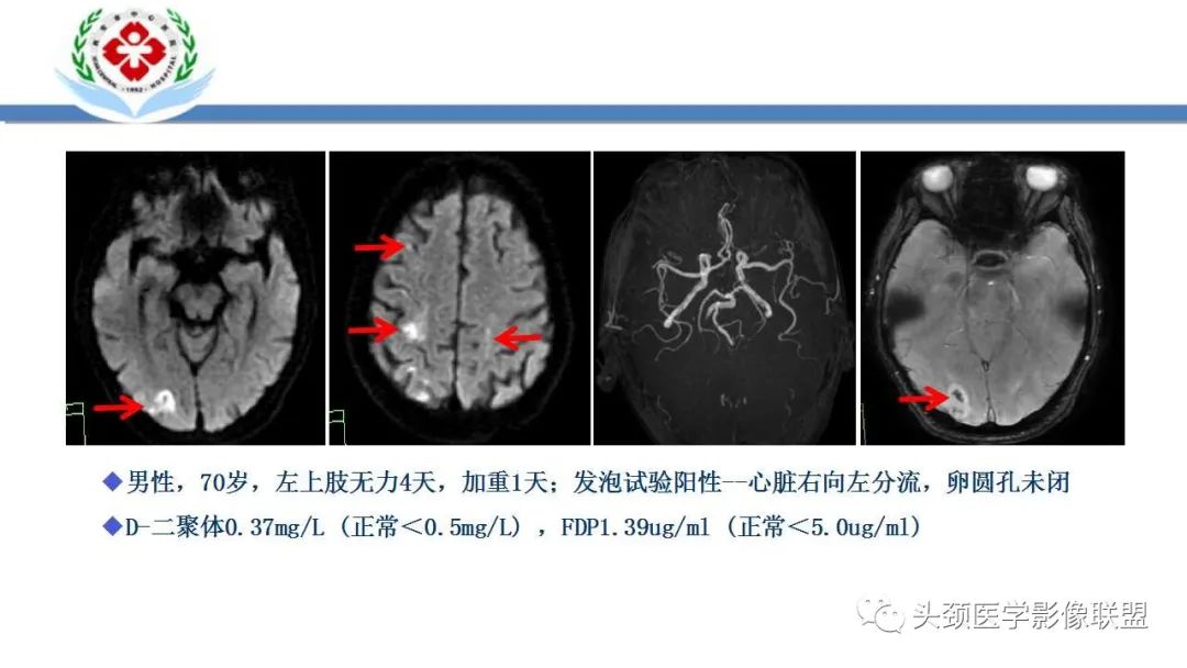 【PPT】特鲁索综合征-28