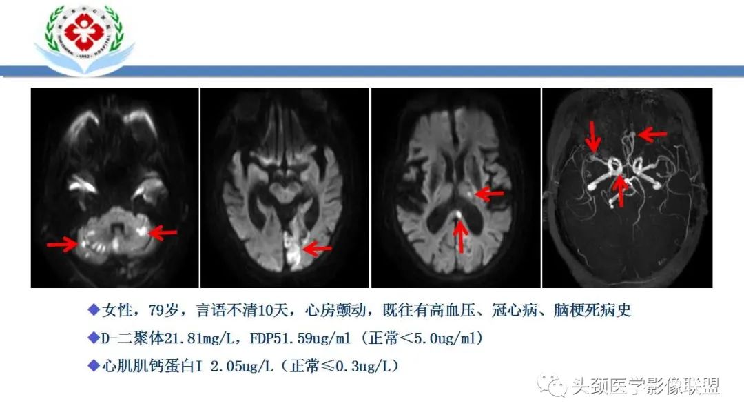【PPT】特鲁索综合征-29
