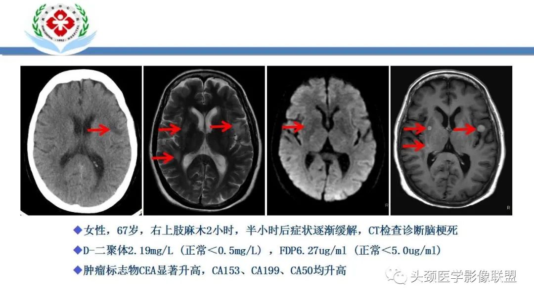 【PPT】特鲁索综合征-31