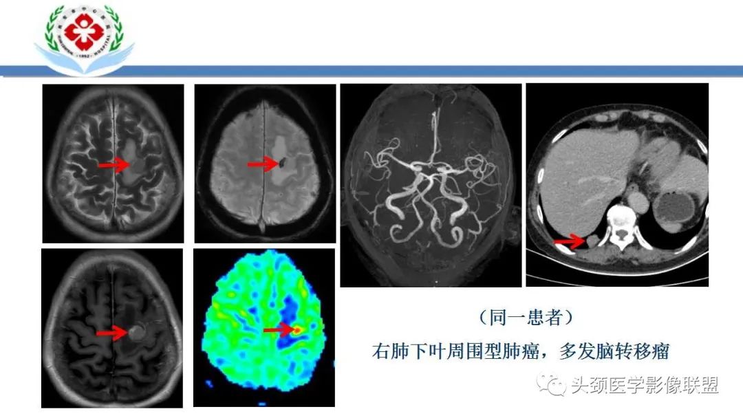 【PPT】特鲁索综合征-32