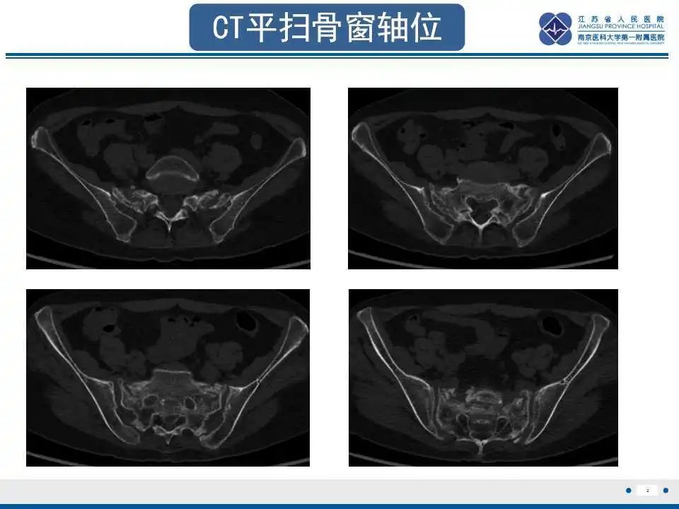 【PPT】骶骨机能不全骨折-3