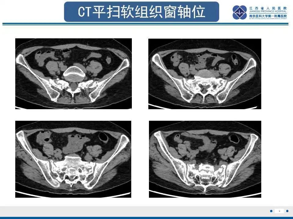 【PPT】骶骨机能不全骨折-4