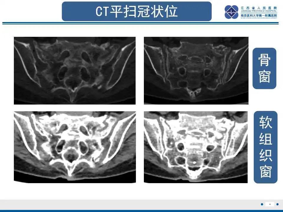 【PPT】骶骨机能不全骨折-5
