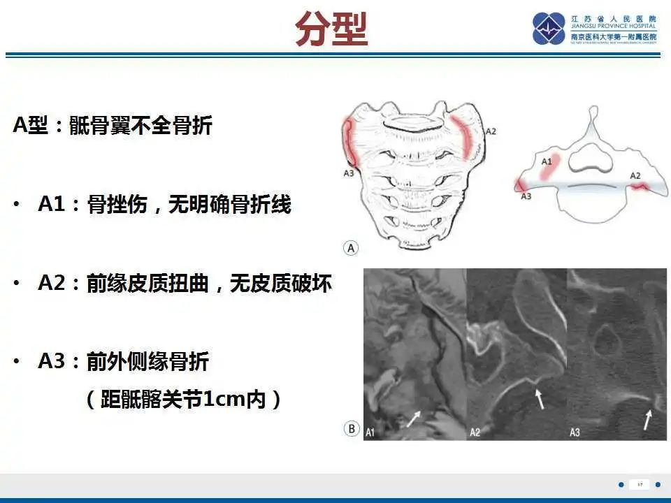【PPT】骶骨机能不全骨折-18