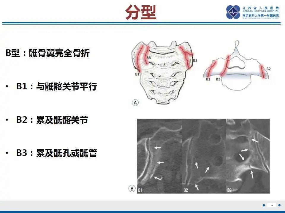 【PPT】骶骨机能不全骨折-19