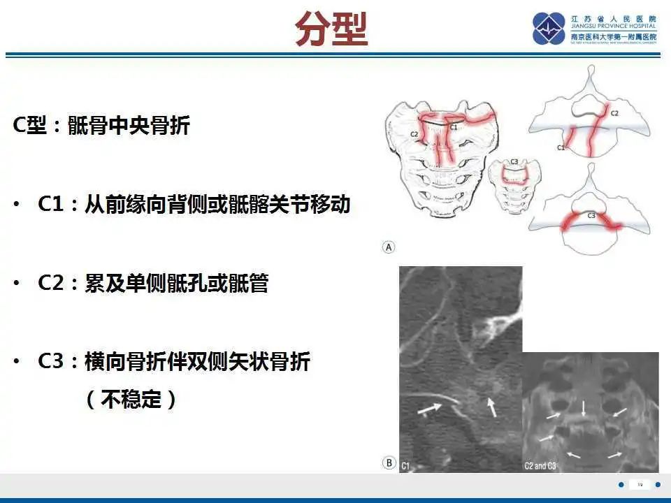 【PPT】骶骨机能不全骨折-20