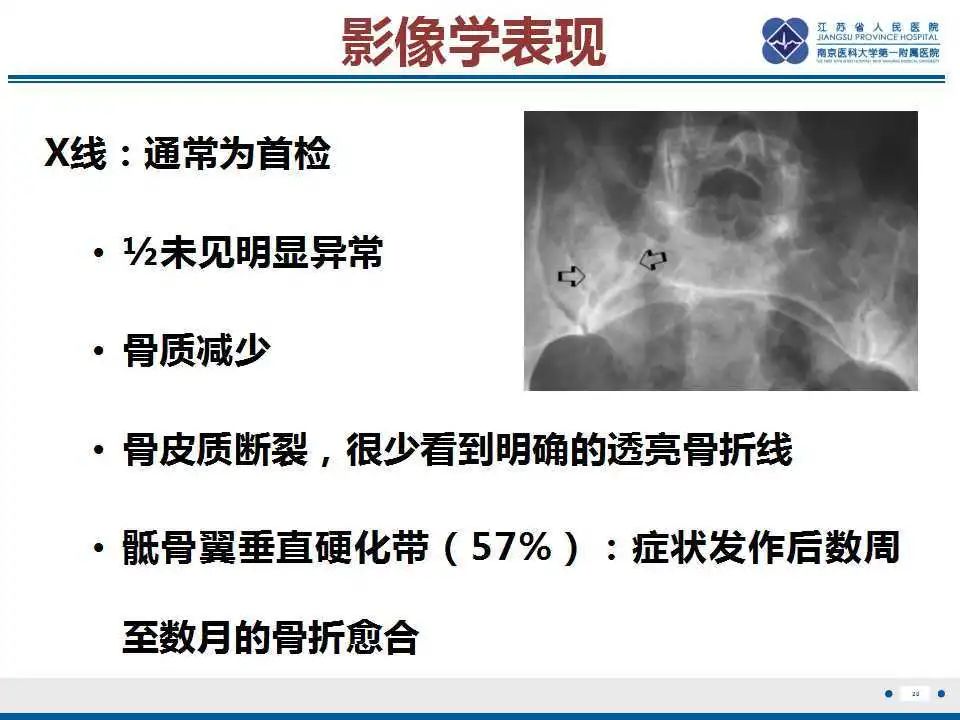 【PPT】骶骨机能不全骨折-21