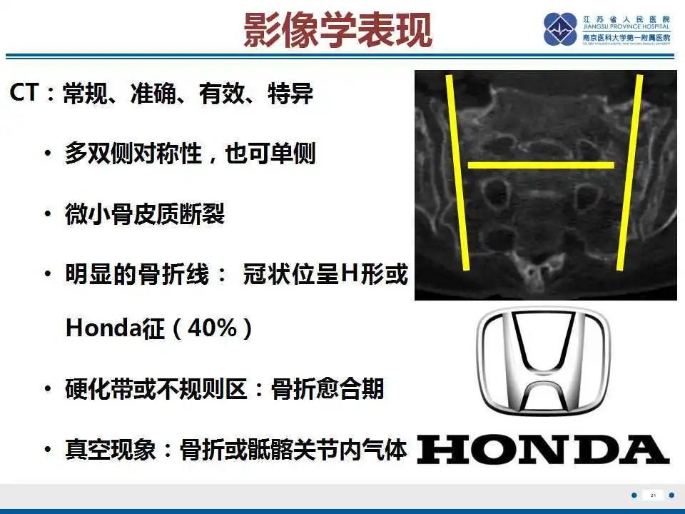 【PPT】骶骨机能不全骨折-22
