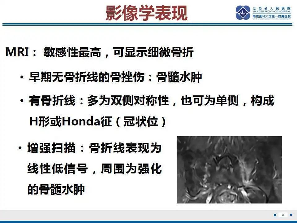 【PPT】骶骨机能不全骨折-23