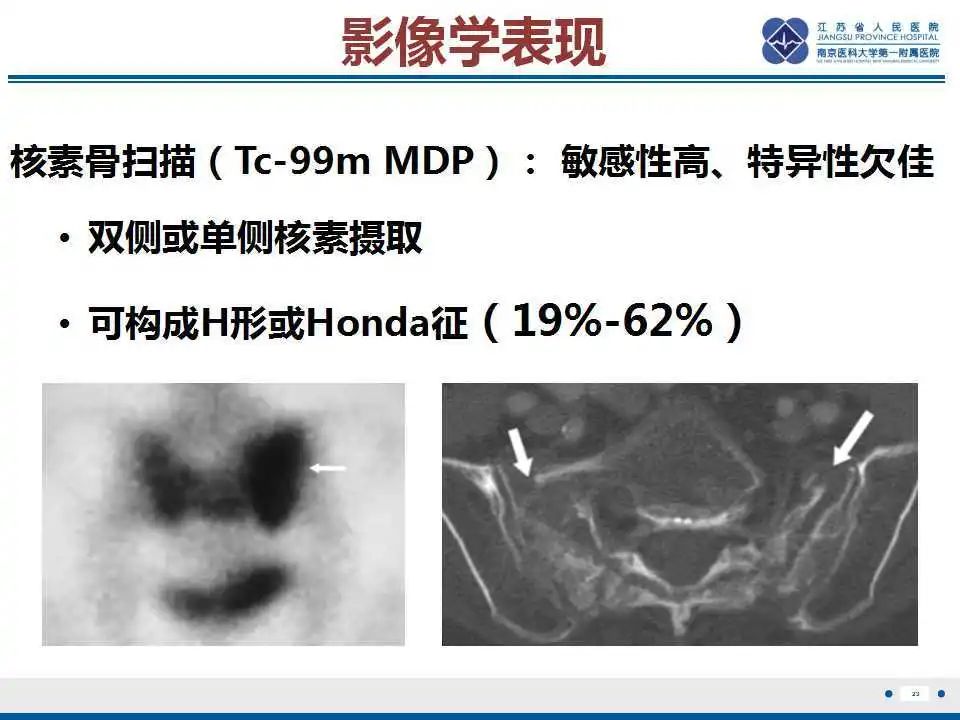 【PPT】骶骨机能不全骨折-24