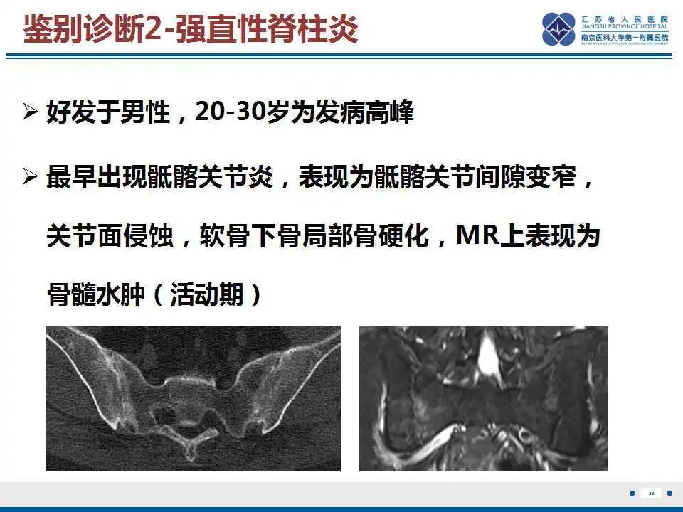 【PPT】骶骨机能不全骨折-29