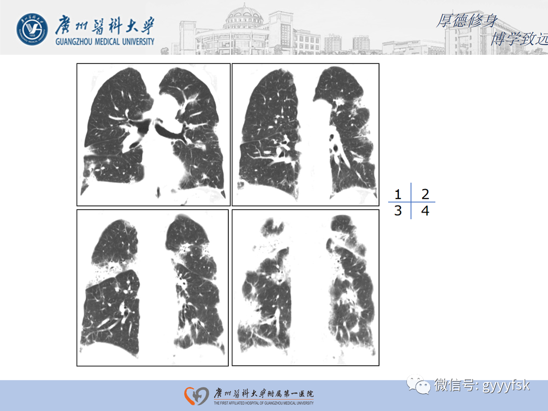 【病例】隐源性机化性肺炎1例CT影像-5