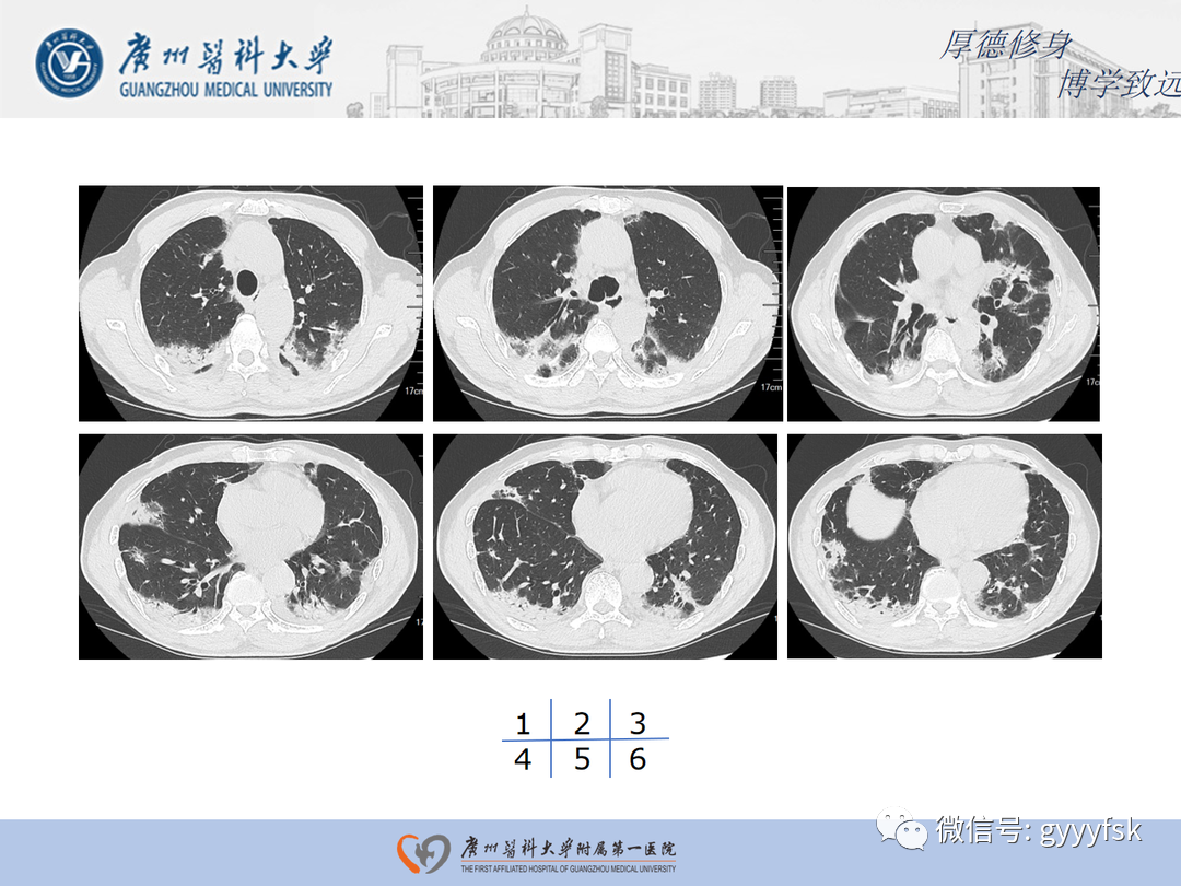 【病例】隐源性机化性肺炎1例CT影像-4