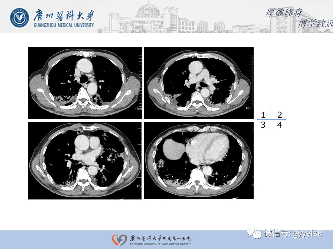 【病例】隐源性机化性肺炎1例CT影像-6